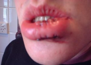 Nathan Hope's busted-lip selfie, the key image from Final Jeopardy! on August 21, 2017.